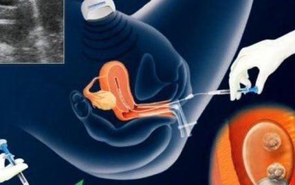 十堰市太和医院做三代试管成功率如何？一文读懂需要花多少钱